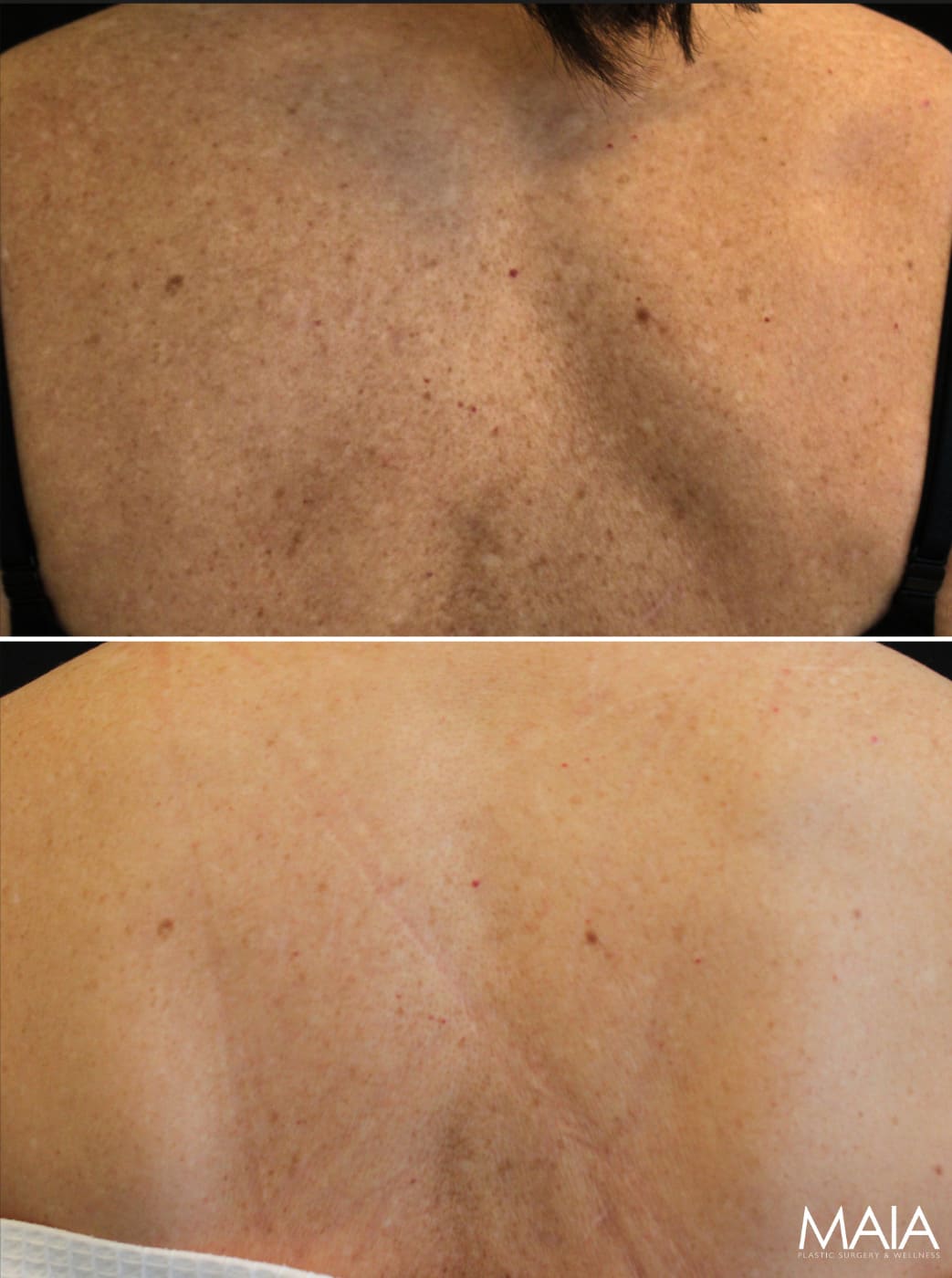 Back skin before and after two sessions of CoolPeel.