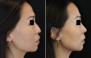 41 year old 3.5 months after Rhinoplasty with cartilage graft, fat graft and nano fat to full face including under eye