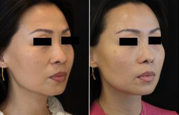41 year old 3.5 months after Rhinoplasty with cartilage graft, fat graft and nano fat to full face including under eye