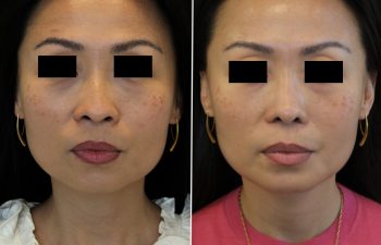 41 year old 3.5 months after Rhinoplasty with cartilage graft, fat graft and nano fat to full face including under eye