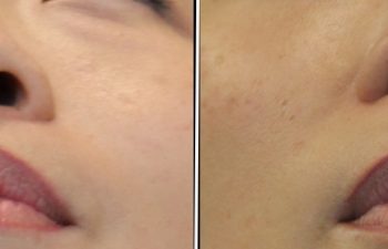 41 year old 3.5 months after Rhinoplasty with cartilage graft, fat graft and nano fat to full face including under eye