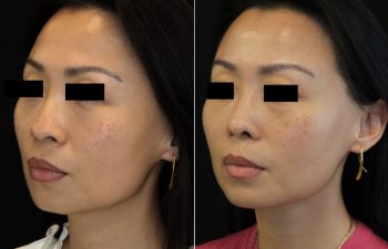 41 year old 3.5 months after Rhinoplasty with cartilage graft, fat graft and nano fat to full face including under eye