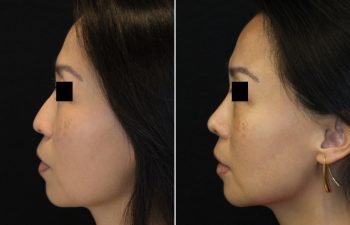 41 year old 3.5 months after Rhinoplasty with cartilage graft, fat graft and nano fat to full face including under eye