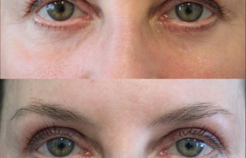 Close-up of a person's eyes shown in two images: the top shows more visible wrinkles and puffiness, while the bottom shows smoother skin and reduced puffiness around the eyes.