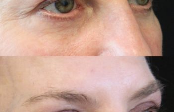 Close-up before-and-after photos of a person's eyes and upper face, showing changes in eyebrow shape and eyelid appearance.