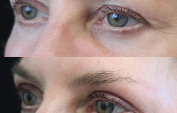 Close-up side-by-side comparison of a person's eyes before and after a cosmetic procedure, showing reduced wrinkles and smoother skin in the after image.
