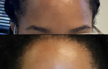 This is our 31-year-old patient who came to our office for the removal of an osteoma—a hard bump on her forehead that had been present for more than two years and was gradually increasing in size. The procedure was performed in a surgical setting under general anesthesia and took approximately one hour. Here she is at her final three-month post-operative visit. The incision has healed beautifully and was placed along the hairline, leaving no visible scar. The bump is completely gone, and the patient is extremely happy with her results.