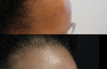 This is our 31-year-old patient who came to our office for the removal of an osteoma—a hard bump on her forehead that had been present for more than two years and was gradually increasing in size. The procedure was performed in a surgical setting under general anesthesia and took approximately one hour. Here she is at her final three-month post-operative visit. The incision has healed beautifully and was placed along the hairline, leaving no visible scar. The bump is completely gone, and the patient is extremely happy with her results.