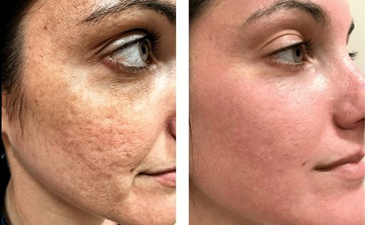 woman before and after halo laser