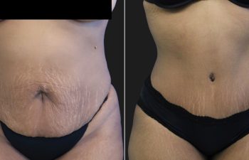 29 year-old mother before and 11 weeks after tummy tuck and flank liposuction.