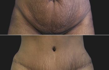 29 year-old mother before and 11 weeks after tummy tuck and flank liposuction.