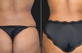 29 year-old mother before and 11 weeks after tummy tuck and flank liposuction.