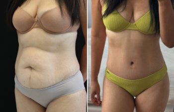 41 year-old before and 6 weeks after extended tummy tuck, muscle repair, and flank liposuction. *After photo taken by patient at home.