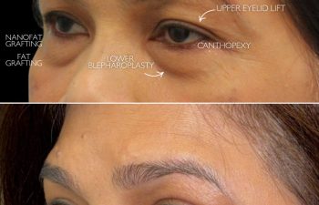 Before-and-after comparison of eye rejuvenation surgery in a 55-year-old patient, showing the upper and lower eyelid areas and the outer corner of the eye with treated regions indicated.