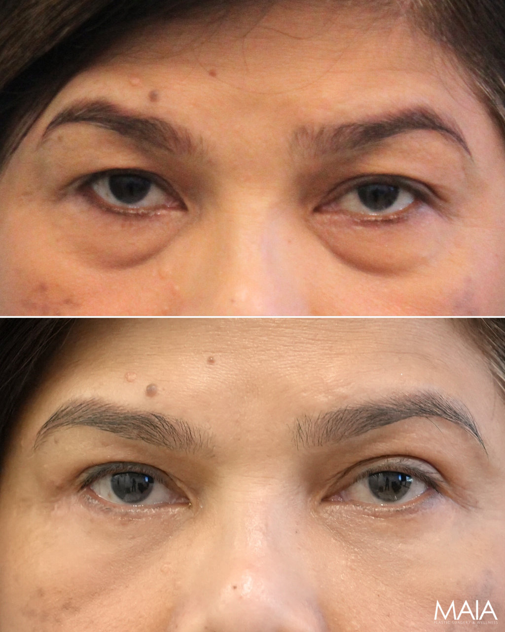 55 year old patient before and 3.5 months after eye rejuvenation upper and lower blepharoplasty canthopexy nanofat grafting with Dr. Maia in Tysons Corner Virginia