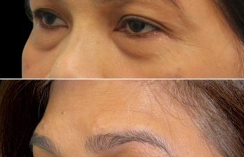 55 year old patient before and 3.5 months after eye rejuvenation upper and lower blepharoplasty canthopexy nanofat grafting with Dr. Maia in Tysons Corner Virginia
