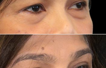 55 year old patient before and 3.5 months after eye rejuvenation upper and lower blepharoplasty canthopexy nanofat grafting with Dr. Maia in Tysons Corner Virginia
