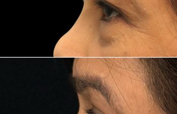 55 year old patient before and 3.5 months after eye rejuvenation upper and lower blepharoplasty canthopexy nanofat grafting with Dr. Maia in Tysons Corner Virginia