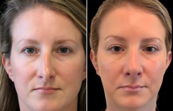 37 year old 2.5 months after rhinoplasty and septoplasty. *Swelling still present. After photos sent by patient from home.