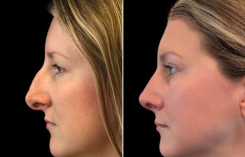 37 year old 2.5 months after rhinoplasty and septoplasty. *Swelling still present. After photos sent by patient from home.