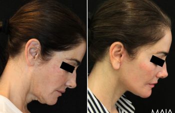 55 year-old patient before and 1.5 months after facial rejuvenation surgery with Dr. Maia in Tysons Corner, Virginia