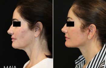 55 year-old patient before and 1.5 months after facial rejuvenation surgery with Dr. Maia in Tysons Corner, Virginia