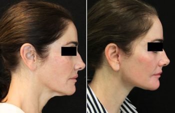 55 year-old patient before and 1.5 months after facial rejuvenation surgery with Dr. Maia in Tysons Corner, Virginia