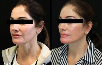 55 year-old patient before and 1.5 months after facial rejuvenation surgery with Dr. Maia in Tysons Corner, Virginia