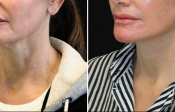 55 year-old patient before and 1.5 months after facial rejuvenation surgery with Dr. Maia in Tysons Corner, Virginia