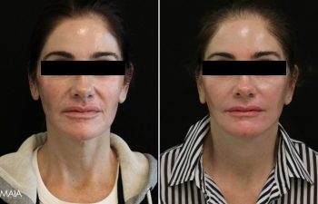 55 year-old patient before and 1.5 months after facial rejuvenation surgery with Dr. Maia in Tysons Corner, Virginia