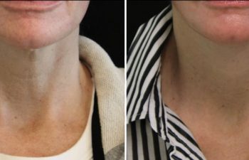 55 year-old patient before and 1.5 months after facial rejuvenation surgery with Dr. Maia in Tysons Corner, Virginia