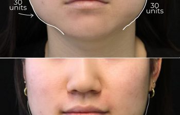Before-and-after comparison of the lower face highlighting the masseter area two weeks after Xeomin treatment in a 25-year-old patient.