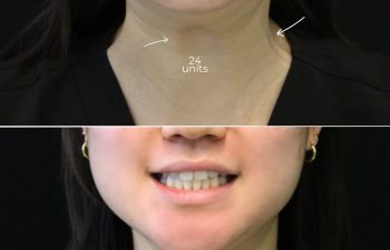 Before-and-after view of the neck area two weeks after Xeomin treatment addressing platysmal activity in a 25-year-old patient.