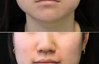 Before-and-after view of the lower face two weeks after Xeomin treatment of the masseter and neck area in a 25-year-old patient.