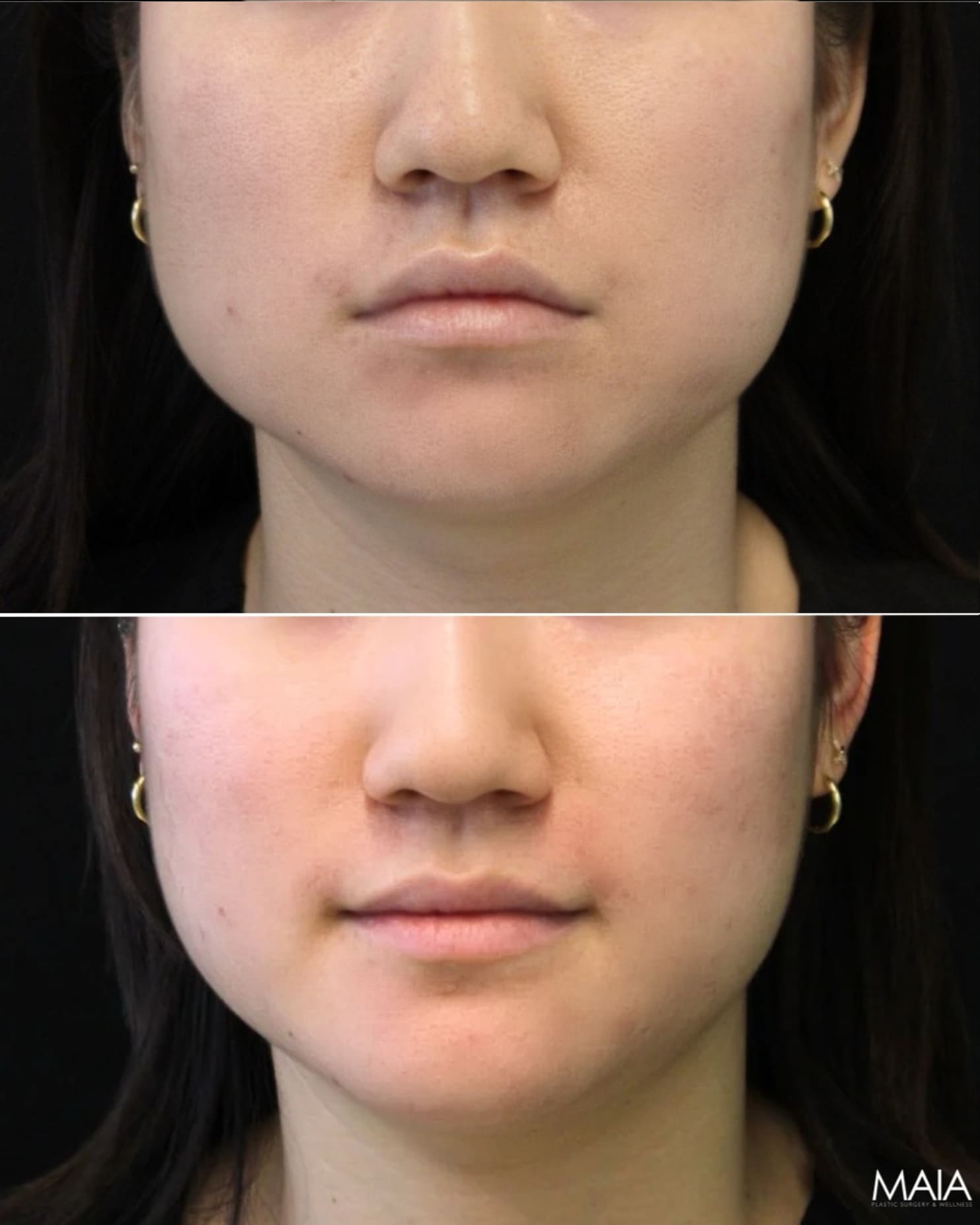 Before-and-after view of the lower face two weeks after Xeomin treatment of the masseter and neck area in a 25-year-old patient.