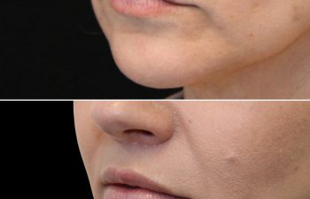 48 Year Old Before and 3 Months After Awake Lip Lift with Dr. Maia in Tysons Corner, Virginia