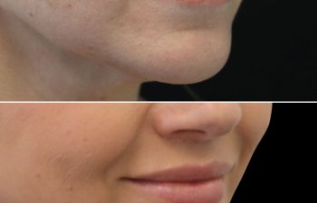 48 Year Old Before and 3 Months After Awake Lip Lift with Dr. Maia in Tysons Corner, Virginia