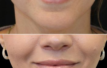 48 Year Old Before and 3 Months After Awake Lip Lift with Dr. Maia in Tysons Corner, Virginia
