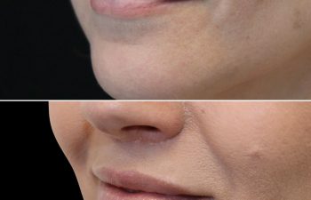 48 Year Old Before and 3 Months After Awake Lip Lift with Dr. Maia in Tysons Corner, Virginia
