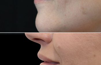 48 Year Old Before and 3 Months After Awake Lip Lift with Dr. Maia in Tysons Corner, Virginia