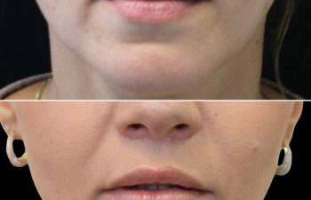 Close-up before-and-after images of the lower face, showing reduced wrinkles and fuller lips in the after photo.