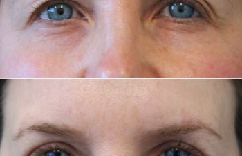 47 year-old before and 7 weeks after upper eyelid lift