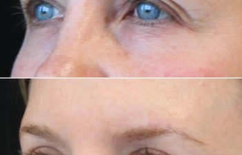 47 year-old before and 7 weeks after upper eyelid lift