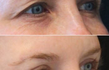47 year-old before and 7 weeks after upper eyelid lift