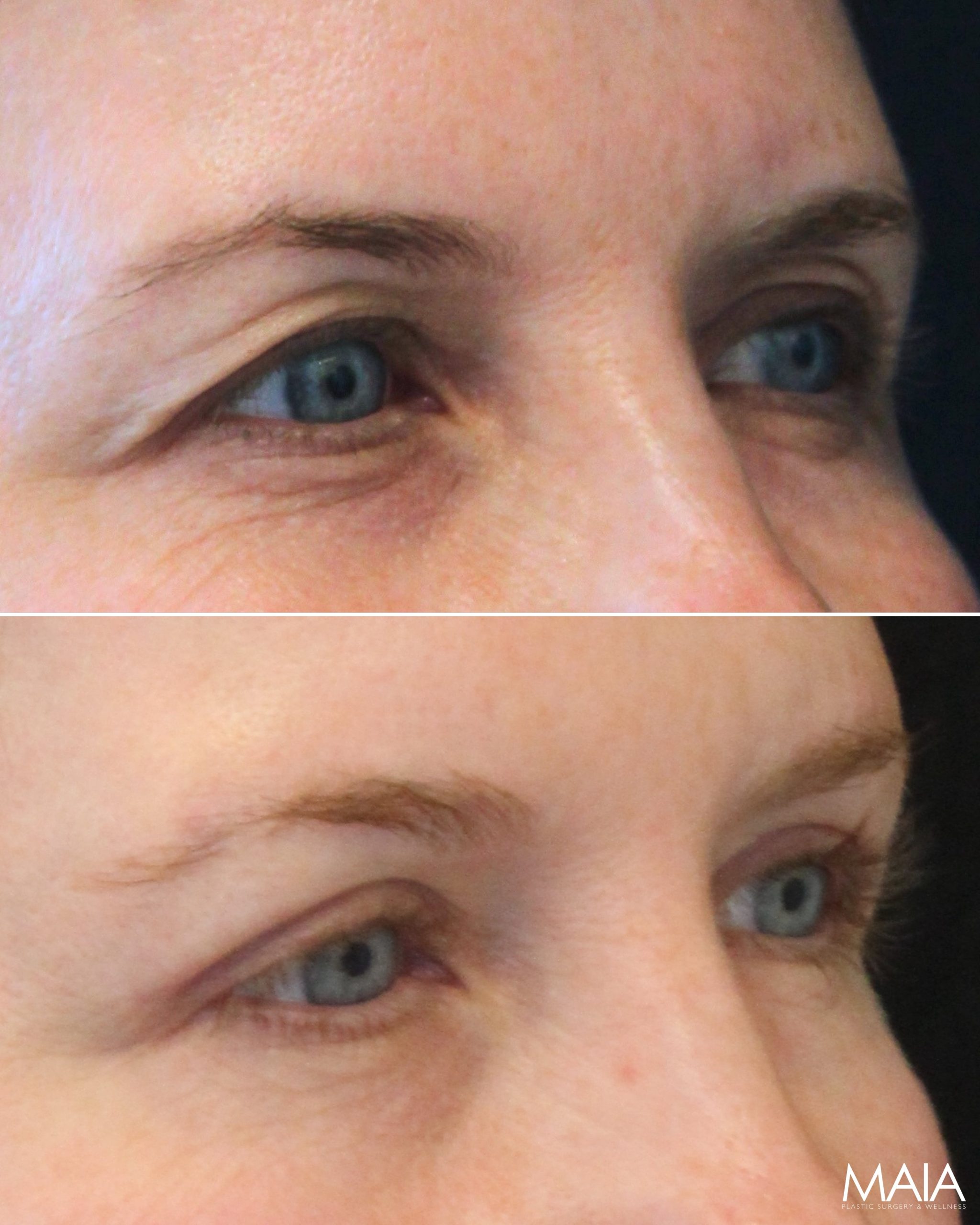 47 year-old before and 7 weeks after upper eyelid lift