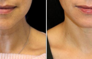 52 year old before and 3 months after an extended neck lift with Dr. Maia in Tysons Corner, VA