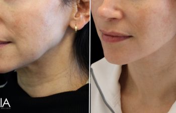 52 year old before and 3 months after an extended neck lift with Dr. Maia in Tysons Corner, VA