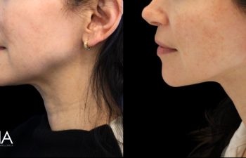 52 year old before and 3 months after an extended neck lift with Dr. Maia in Tysons Corner, VA