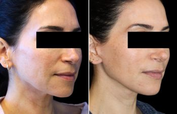 52 year old before and 3 months after an extended neck lift with Dr. Maia in Tysons Corner, VA