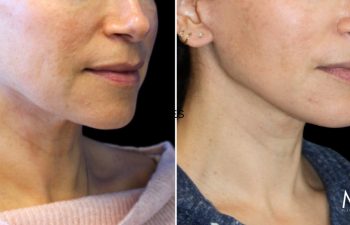 52 year old before and 3 months after an extended neck lift with Dr. Maia in Tysons Corner, VA